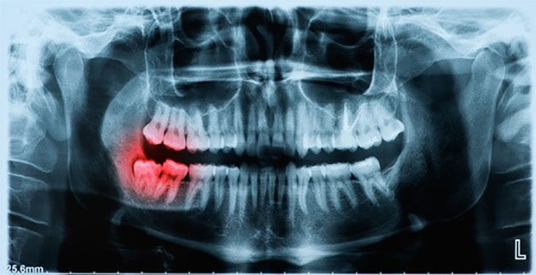 dental x-rays