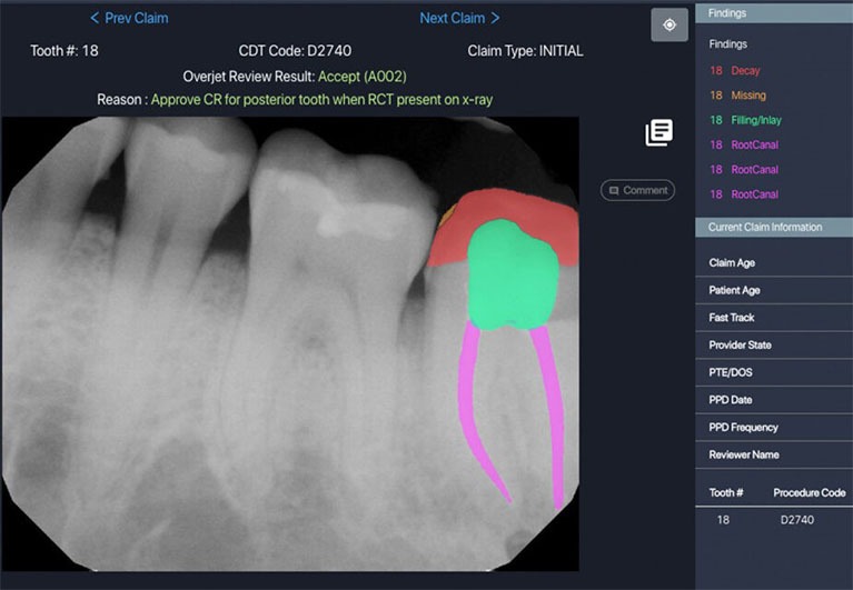 AI Detection with Overjet