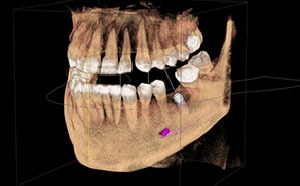 Dental CT Scans