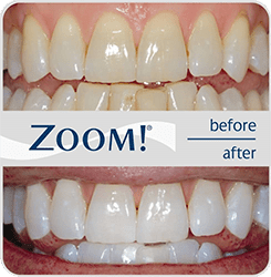 Zoom Whitening at Ponce Dental Studio