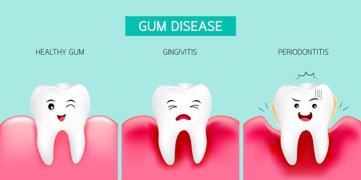 Gum Disease