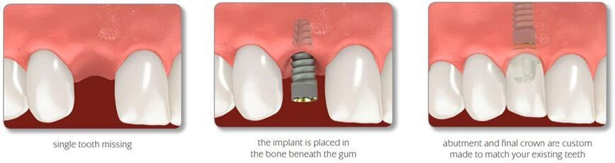 Single tooth implants