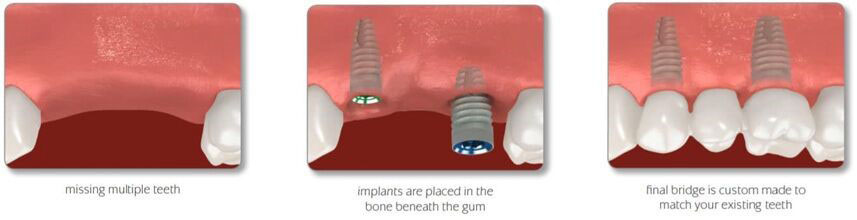 Single tooth implant