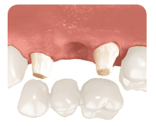 dental bridges faq