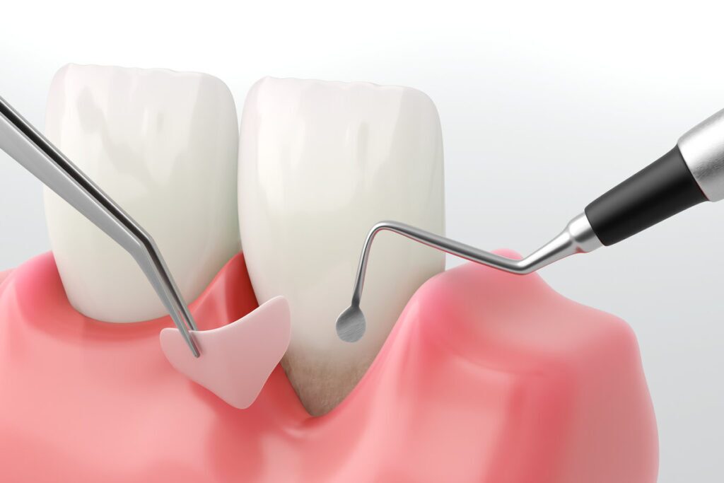 Periodontitis Treatment: A Close-up of Gum Graft Surgery. 3D Illustration.