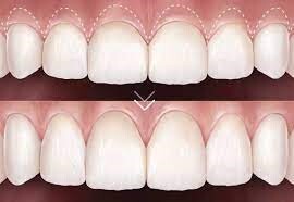 gum lifts before after