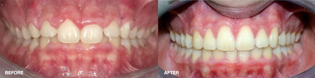 gum lift before after image 3