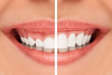 gum lift before after image 2